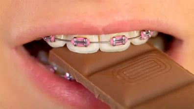 How To Eat With Braces - A Comprehensive Guide To Orthodontic Care